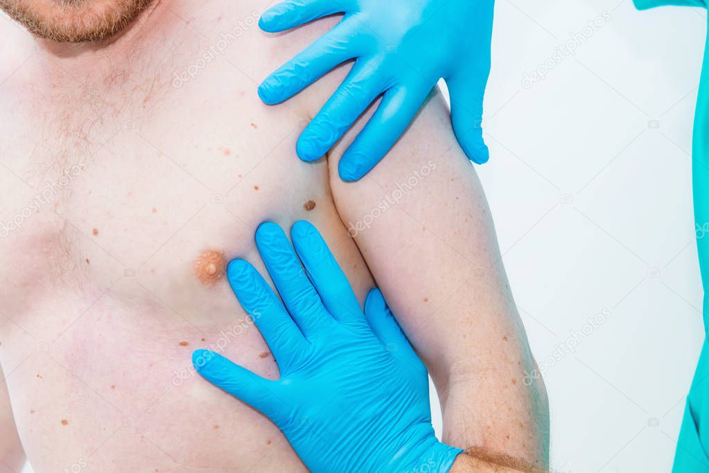 Close up Doctor dermatologist hands in gloves examines underarm birthmark of male patient in clinic. Checking benign moles. Cancer concept. Selective focus. Copy space