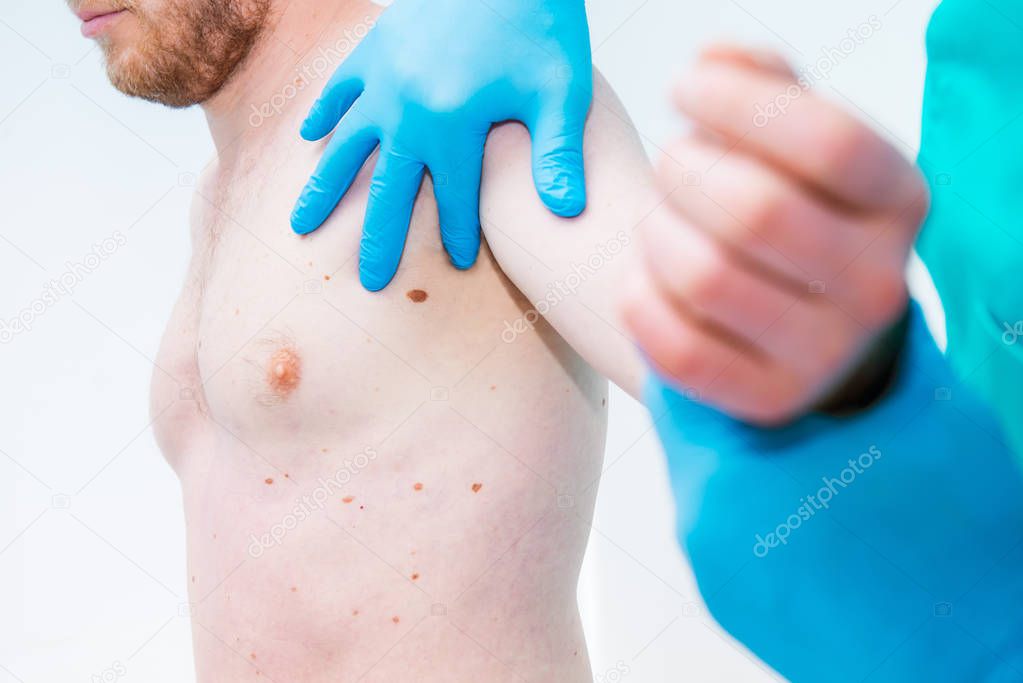 Close up Doctor dermatologist hands in gloves examines underarm birthmark of male patient in clinic. Checking benign moles. Cancer concept. Selective focus. Copy space