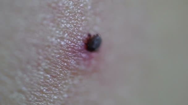 Tick Fastened to Human Skin Feeding on Blood — Stock Video