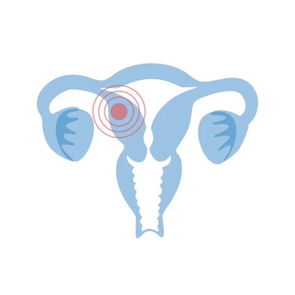 Ilustración aislada vectorial del útero con dolor — Vector de stock