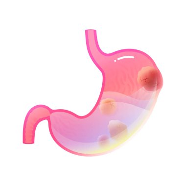 Vektör izole mide kanseri Illustration 