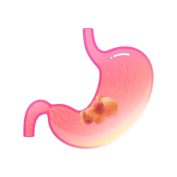 Illustrazione isolata vettoriale del cancro allo stomaco — Vettoriale Stock