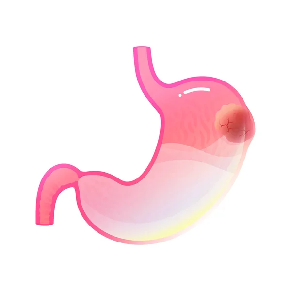 Illustration vectorielle isolée du cancer de l'estomac — Image vectorielle