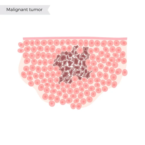 Illustrazione isolata vettoriale del tumore maligno — Vettoriale Stock