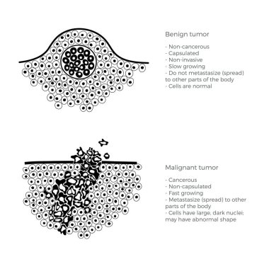 Malign ve benign tümör vektör Illustration