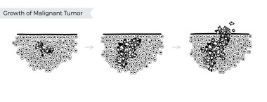 Malign tümör vektör izole Illustration