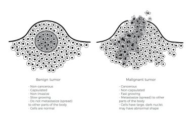 Malign ve benign tümör vektör Illustration