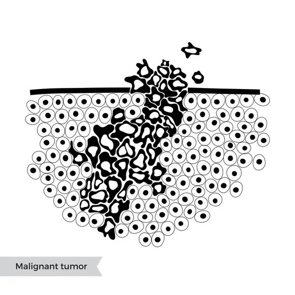 Vector isolated illustration of malignant tumor — Stock Vector