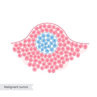 Benign tümörün vektör izole illüstrasyonu 