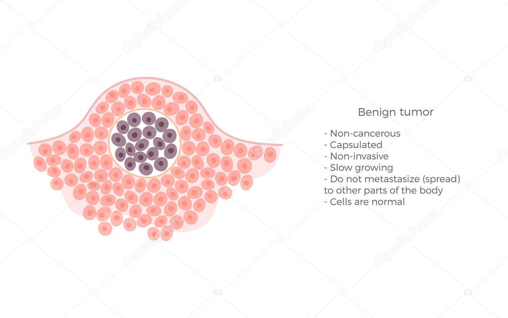 Vector isolated illustration of benign tumor 