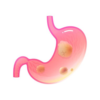 Vektör izole mide kanseri Illustration 