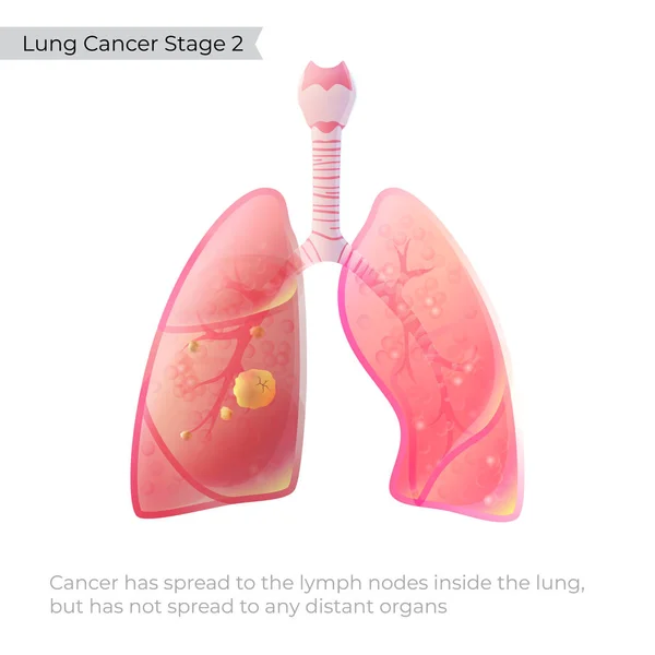 肺癌のベクターイラスト — ストックベクタ