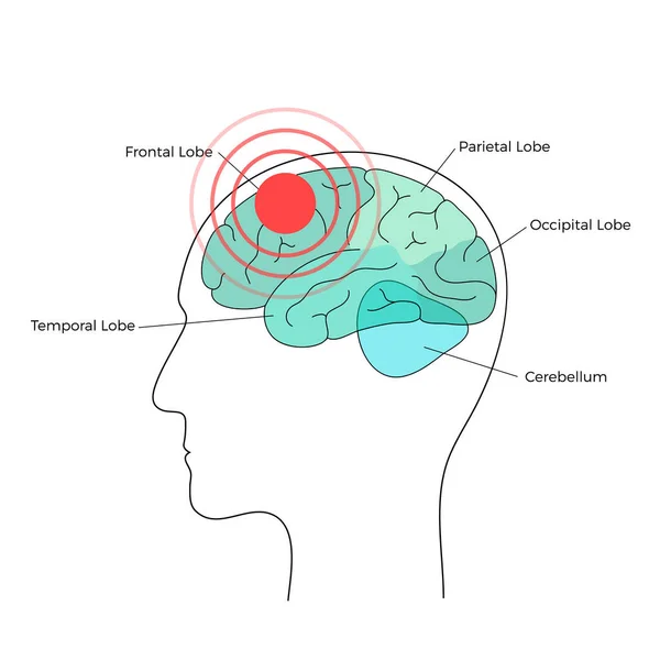 Ilustración del dolor cerebral — Vector de stock