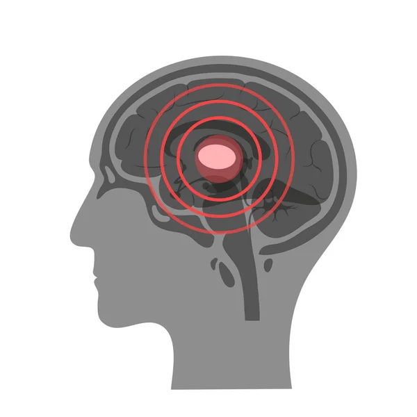 Πόνος Εγκεφαλική απεικόνιση — Διανυσματικό Αρχείο