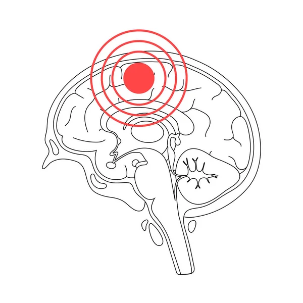 Ilustración del dolor cerebral — Vector de stock