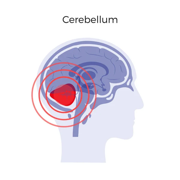 Ilustración del dolor cerebral — Vector de stock