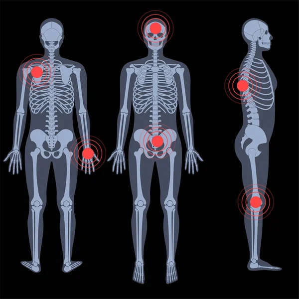 Röntgenfoto van skeletten — Stockvector