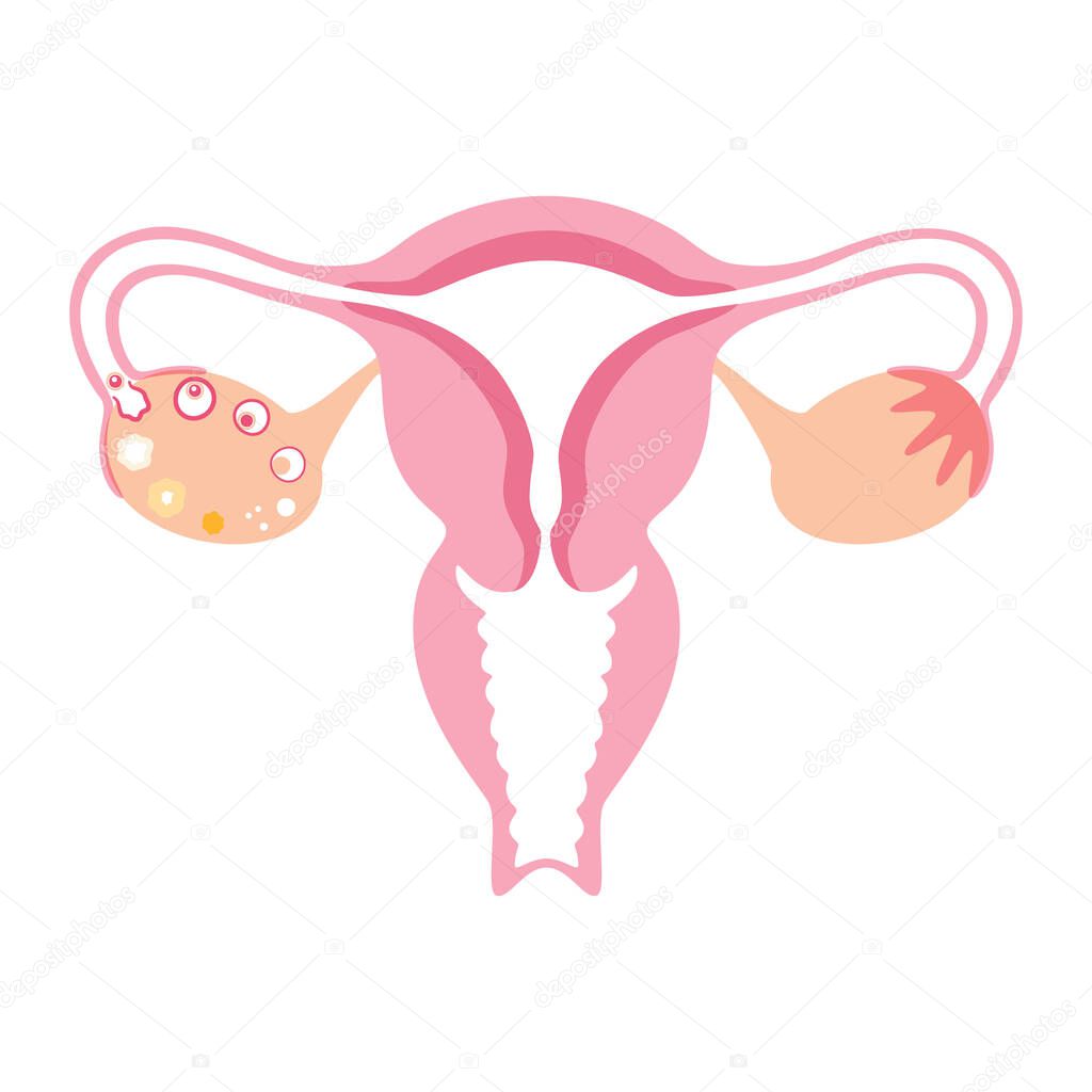 Uterus and ovary anatomy and woman health concept. Womb icon or logo. Ovum development. Human female reproductive system on diagram. Gynecology medical poster for clinic. Flat vector illustration.