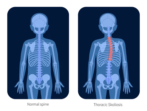 Radiografía de columna vertebral — Vector de stock