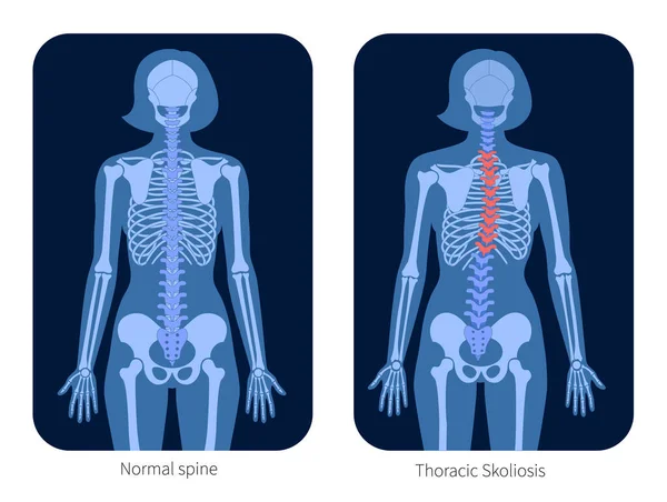 Spine X-ray — стоковый вектор