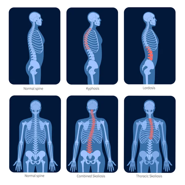 Spine X ray — Stock Vector