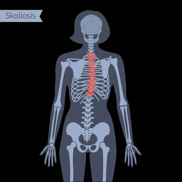 Radiografía de columna vertebral — Archivo Imágenes Vectoriales