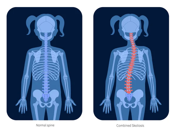 Radiografía de columna vertebral — Vector de stock