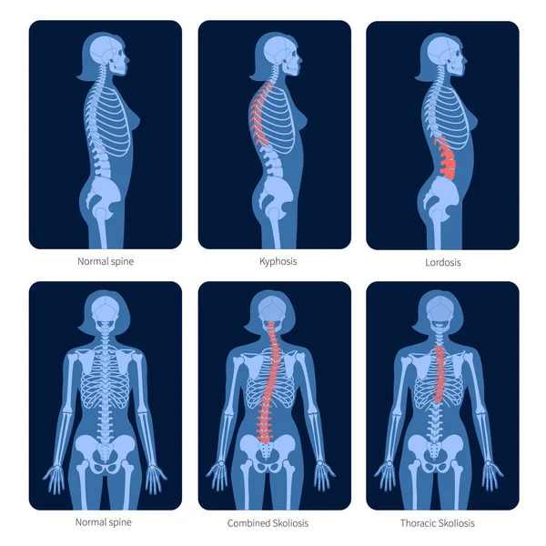 Röntgenbild der Wirbelsäule — Stockvektor