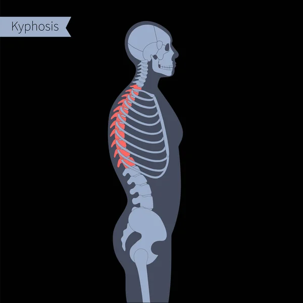 Radiografía de columna vertebral — Archivo Imágenes Vectoriales