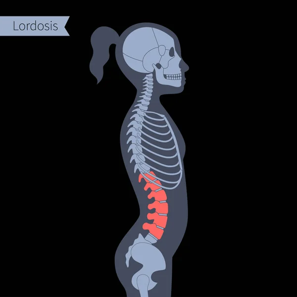 Radiografía de columna vertebral — Archivo Imágenes Vectoriales