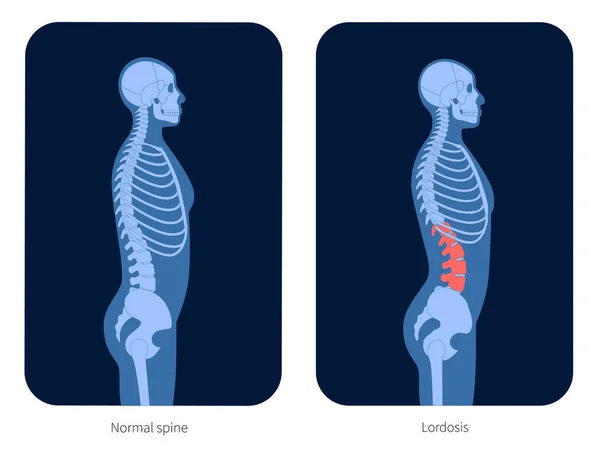 Radiografía de columna vertebral — Vector de stock