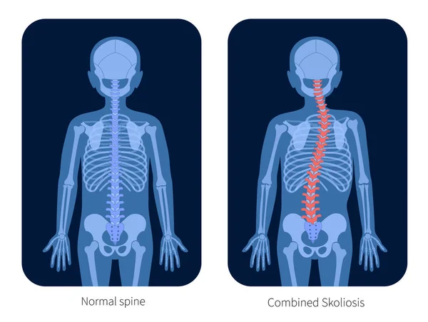 Radiografía de columna vertebral — Archivo Imágenes Vectoriales