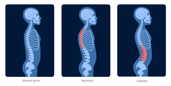 Raggi X della colonna vertebrale — Vettoriale Stock