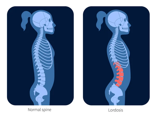 Radiografía de columna vertebral — Vector de stock