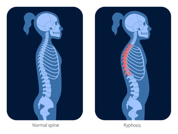 脊柱 x 射线 — 图库矢量图片