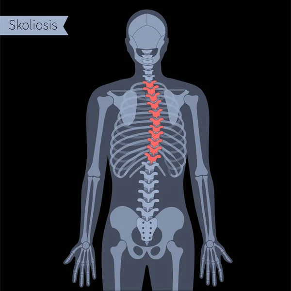 Spine X ray — Stock Vector