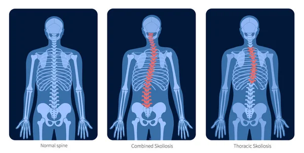 Radiografía de columna vertebral — Archivo Imágenes Vectoriales