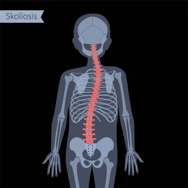 Radiografía de columna vertebral — Vector de stock
