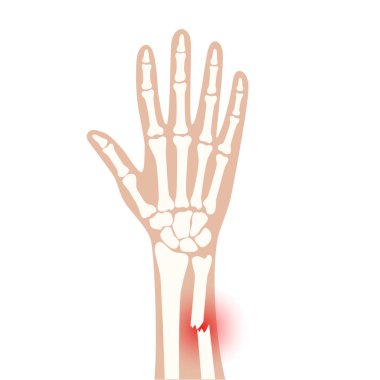 Fraktür x ışını konsepti