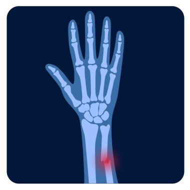 Fraktür x ışını konsepti