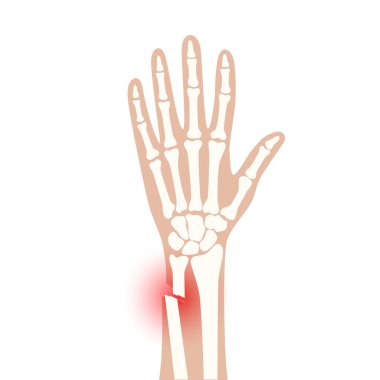 Fraktür x ışını konsepti