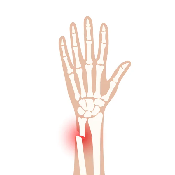 骨折x線の概念 — ストックベクタ