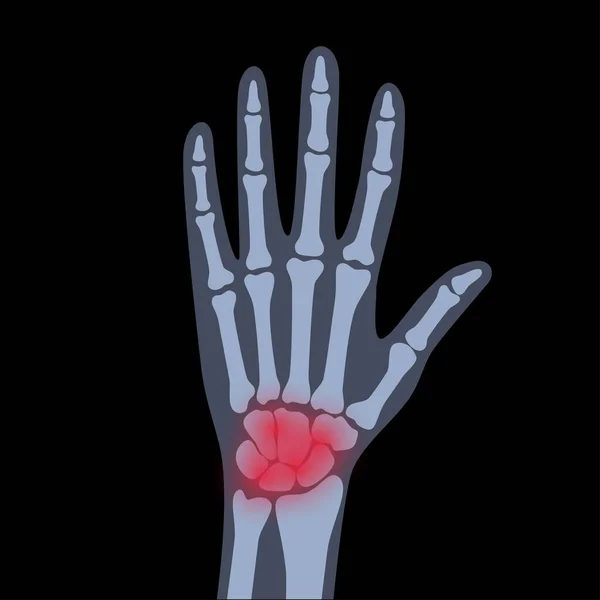 Arthriten-Röntgen — Stockvektor
