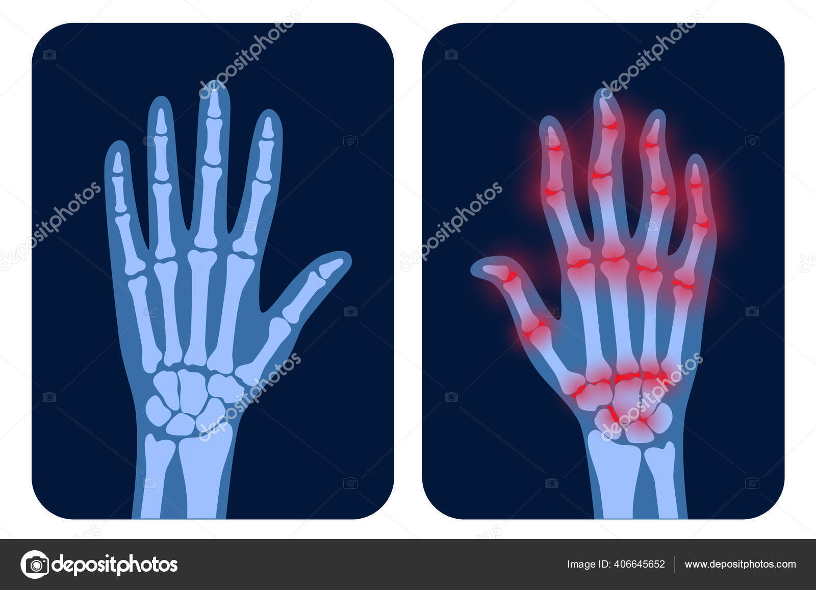 Artrits rayos X vector, gráfico vectorial © Pikovit imagen #406645652 Artrits rayos X vector, gráfico vectorial © Pikovit imagen #406645652