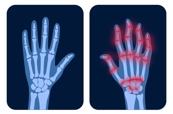 Röntgenfoto 's van Arthrits — Stockvector