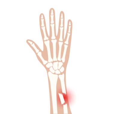 Fraktür x ışını konsepti