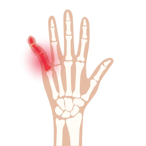 Arthrits x ray — 图库矢量图片