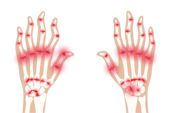 Rentgen artritidy — Stockový vektor