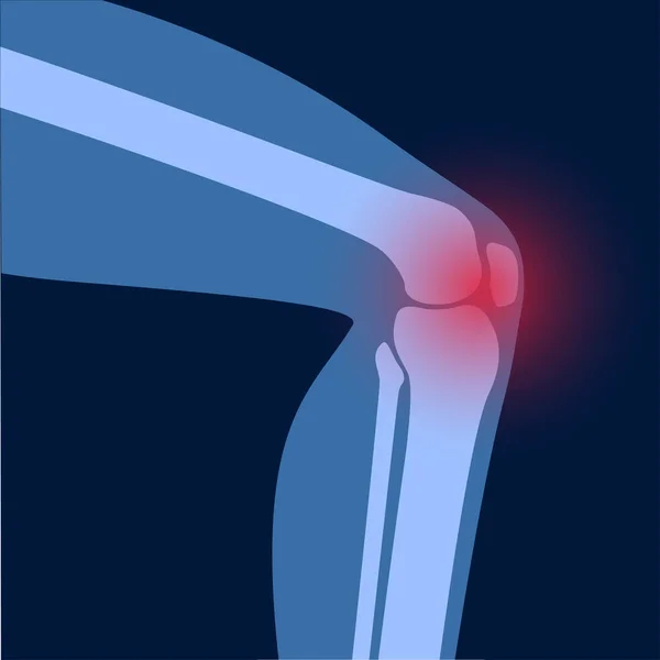 무릎 관절의 관절염 — 스톡 벡터