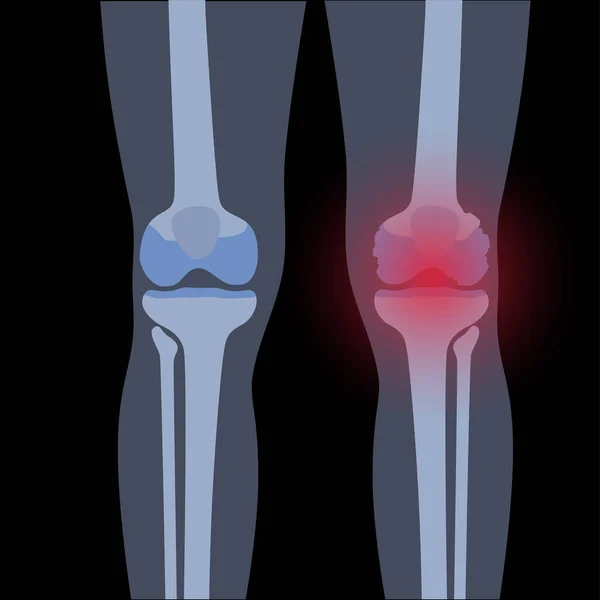 Arthritis in knee joint — Stock Vector